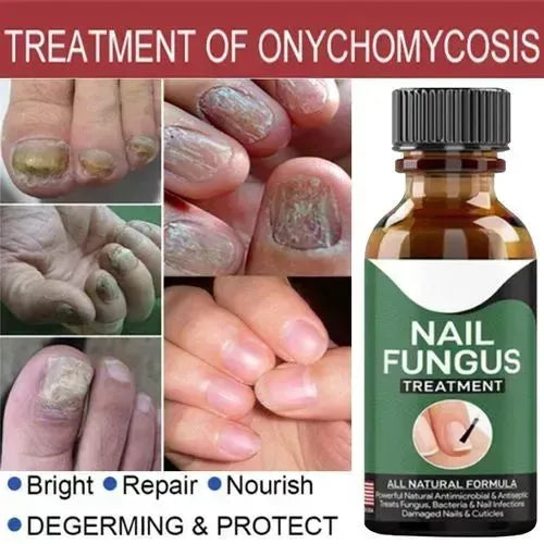 Fast Nail Fungus Treatment Serum (15ml)
